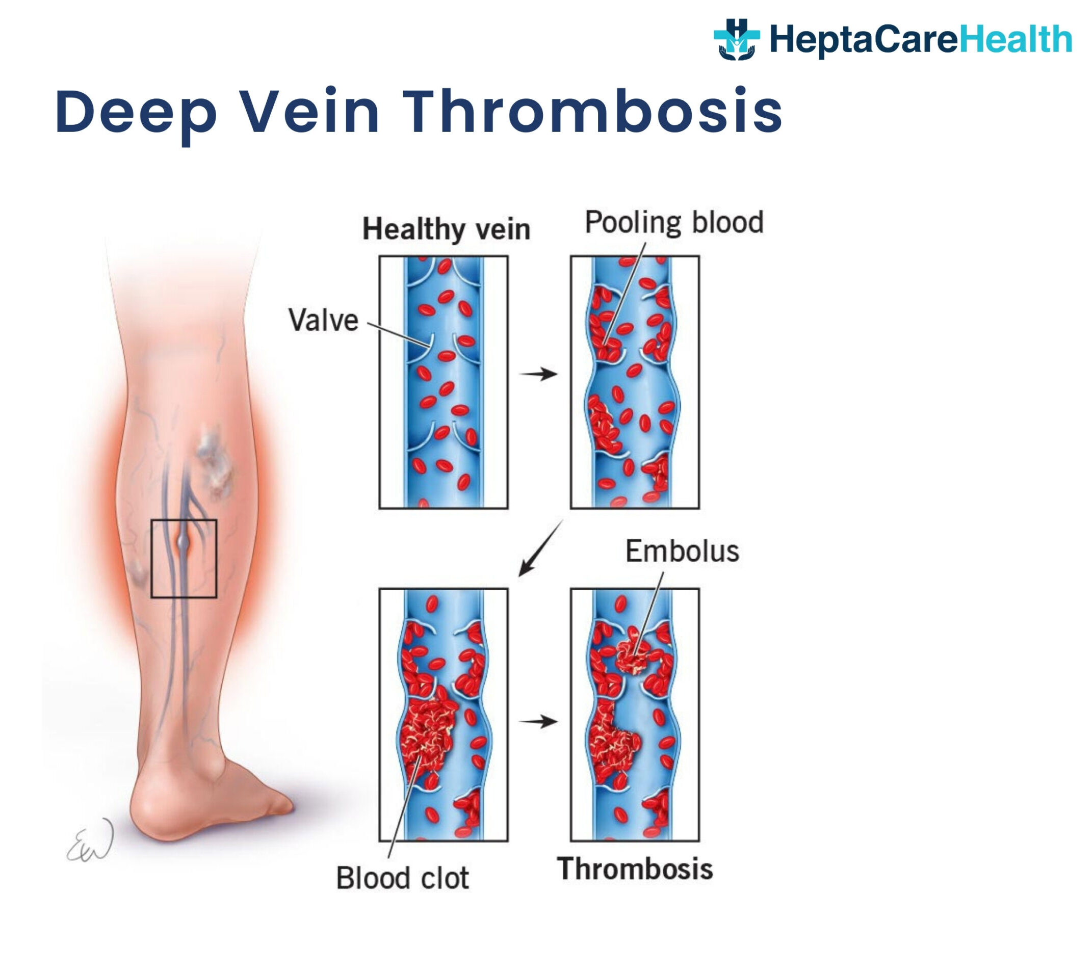 DVT treatment
