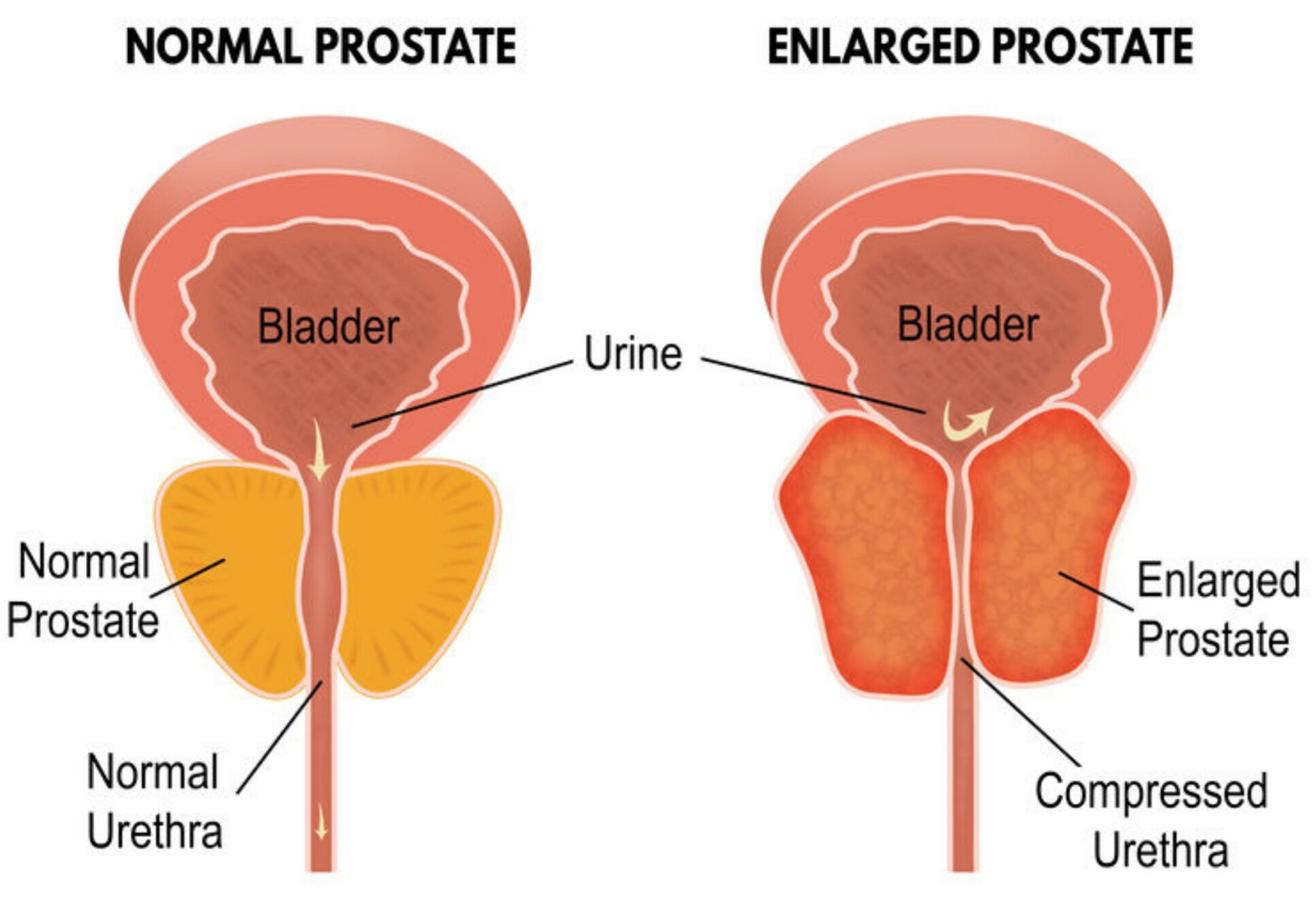 Enlarged prostate