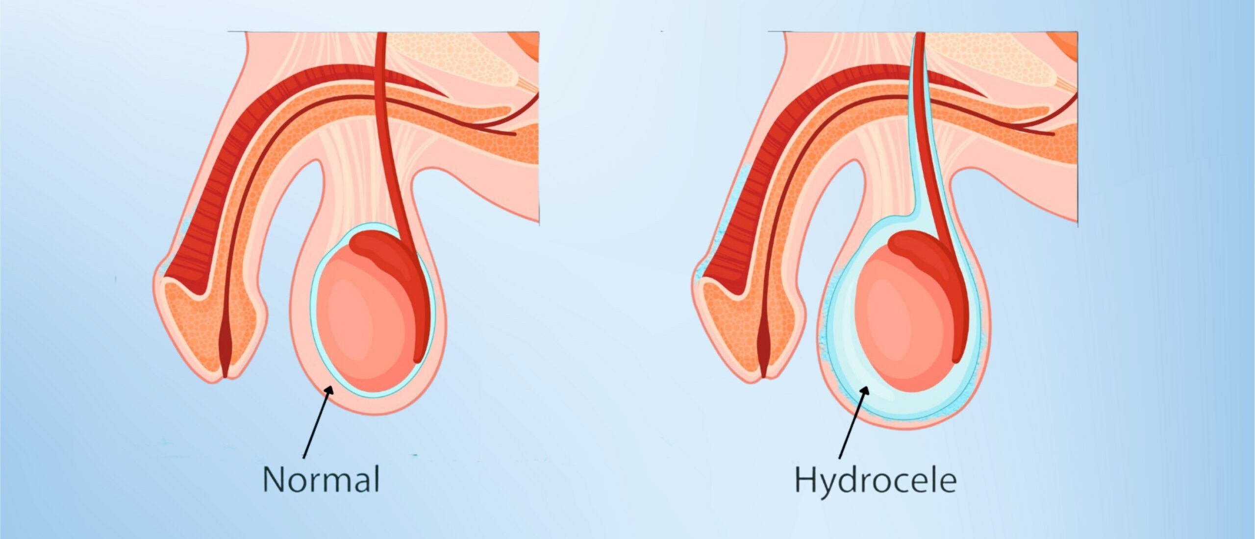Hydrocelectomy