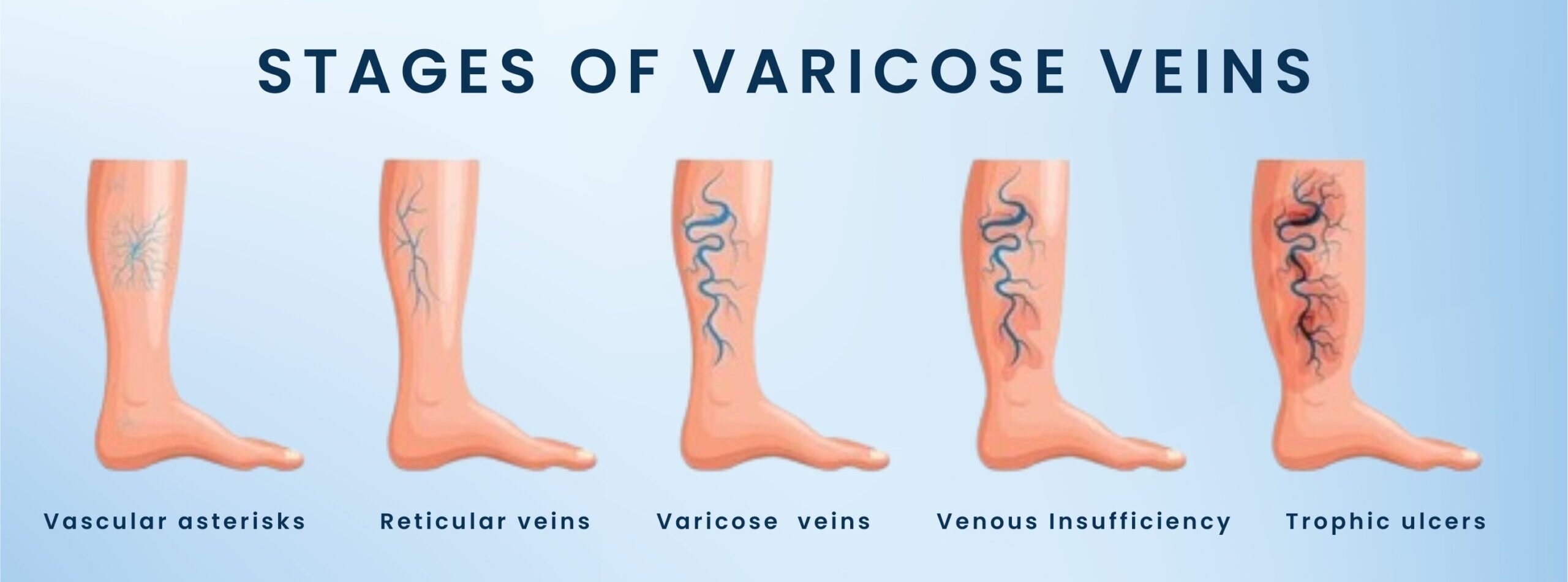 Varicose veins