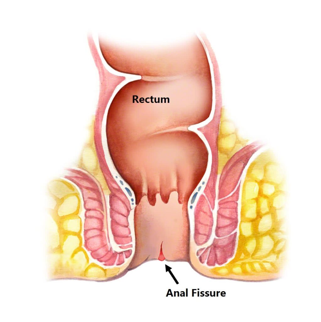 Fissure