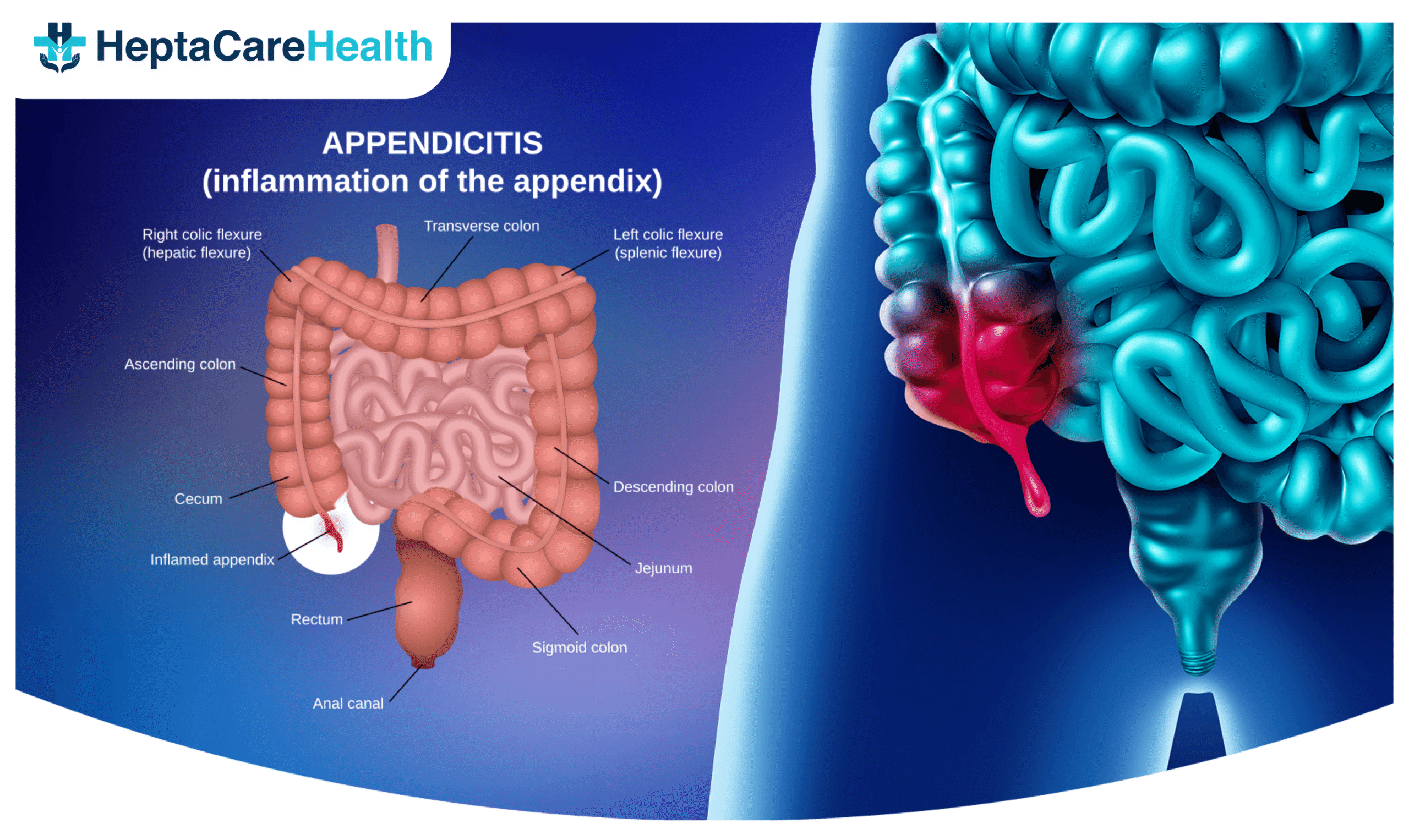 appendicitis