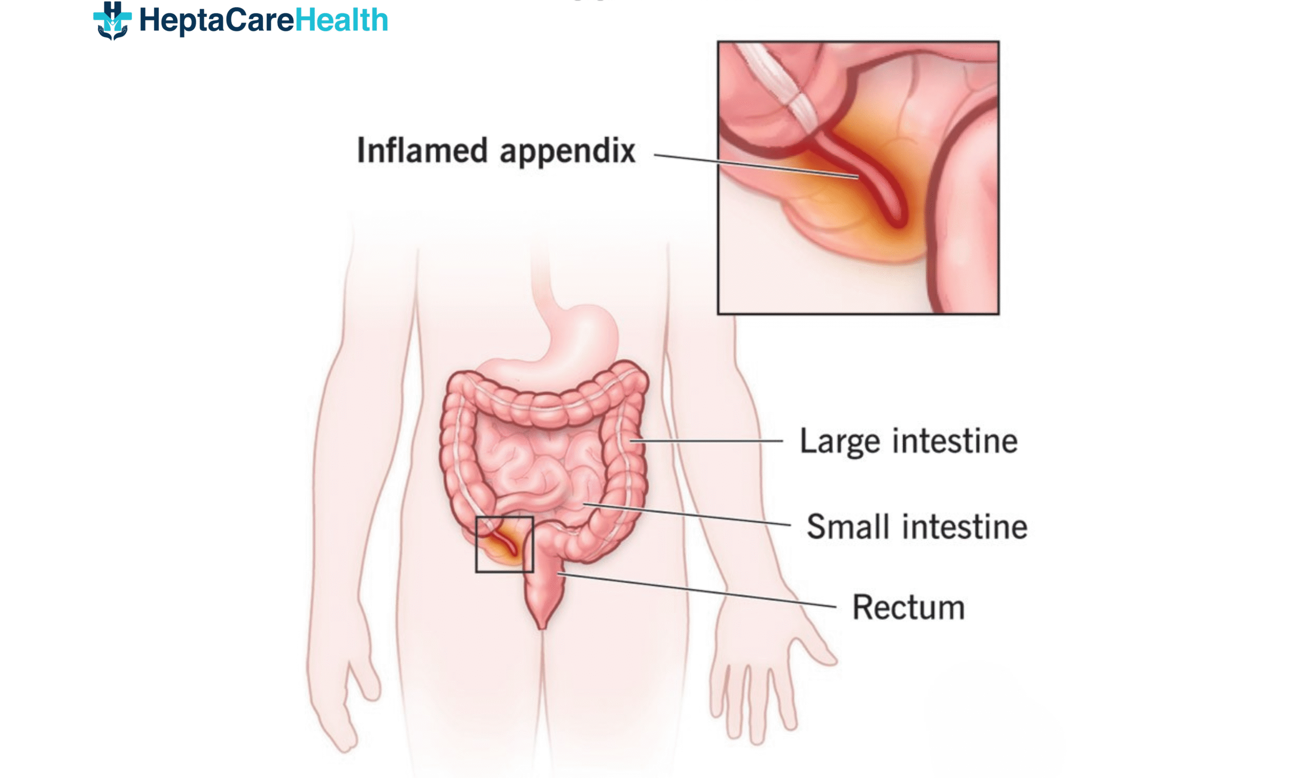 appendicitis