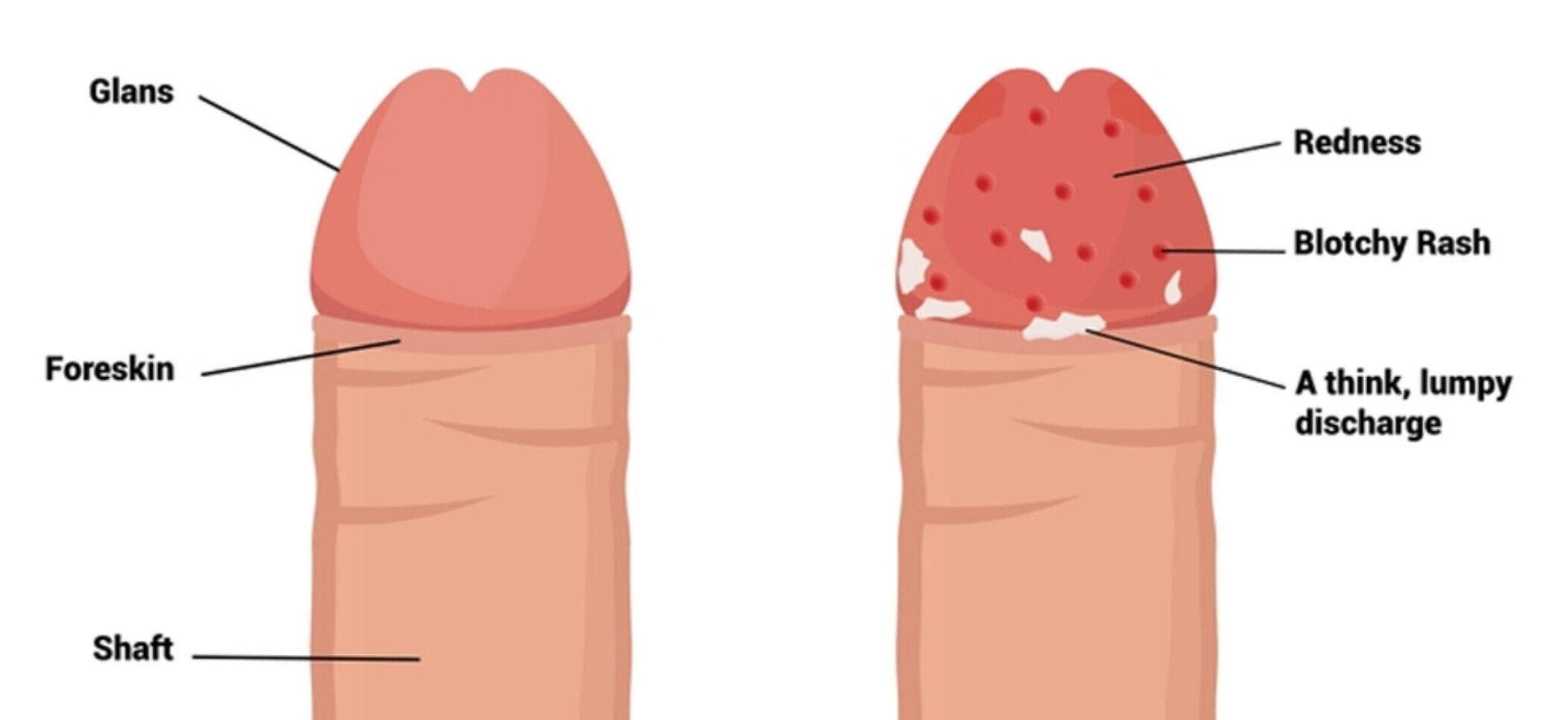 Balanitis