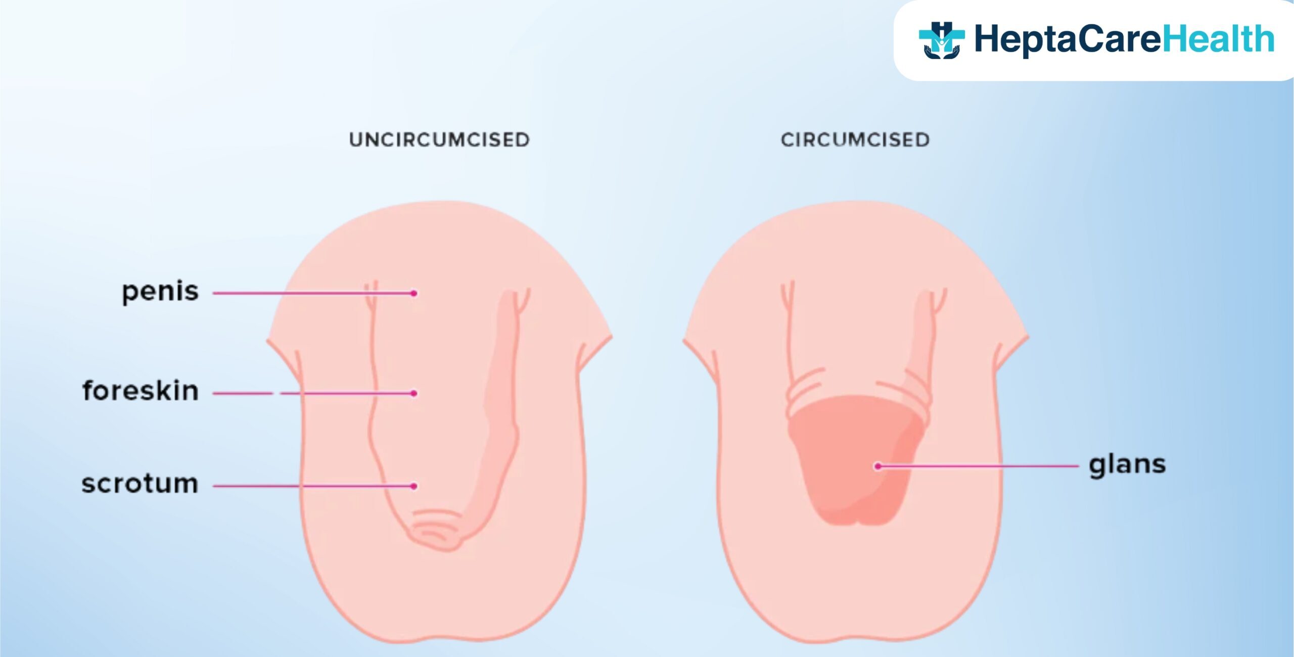 Circumcision