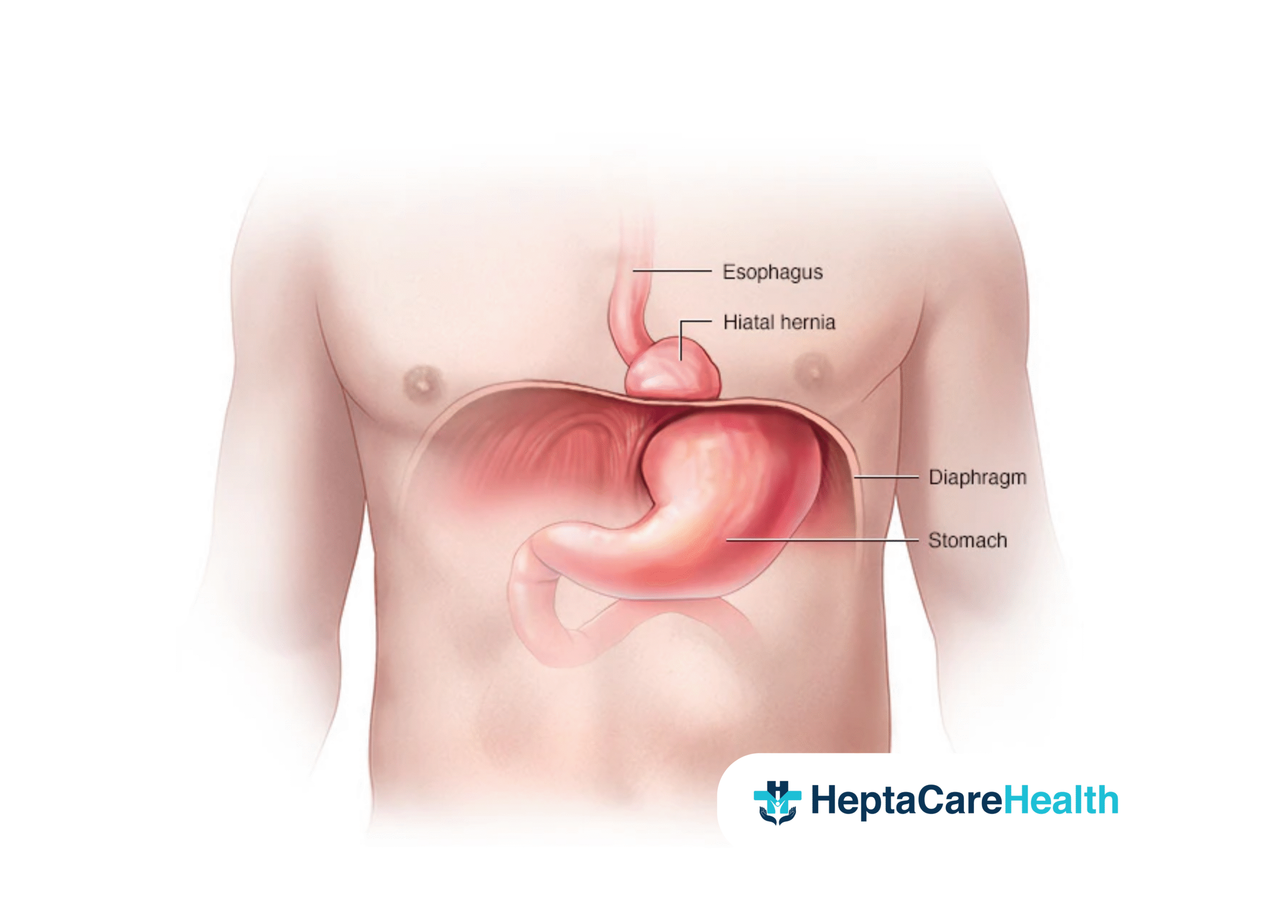 Hiatal hernia
