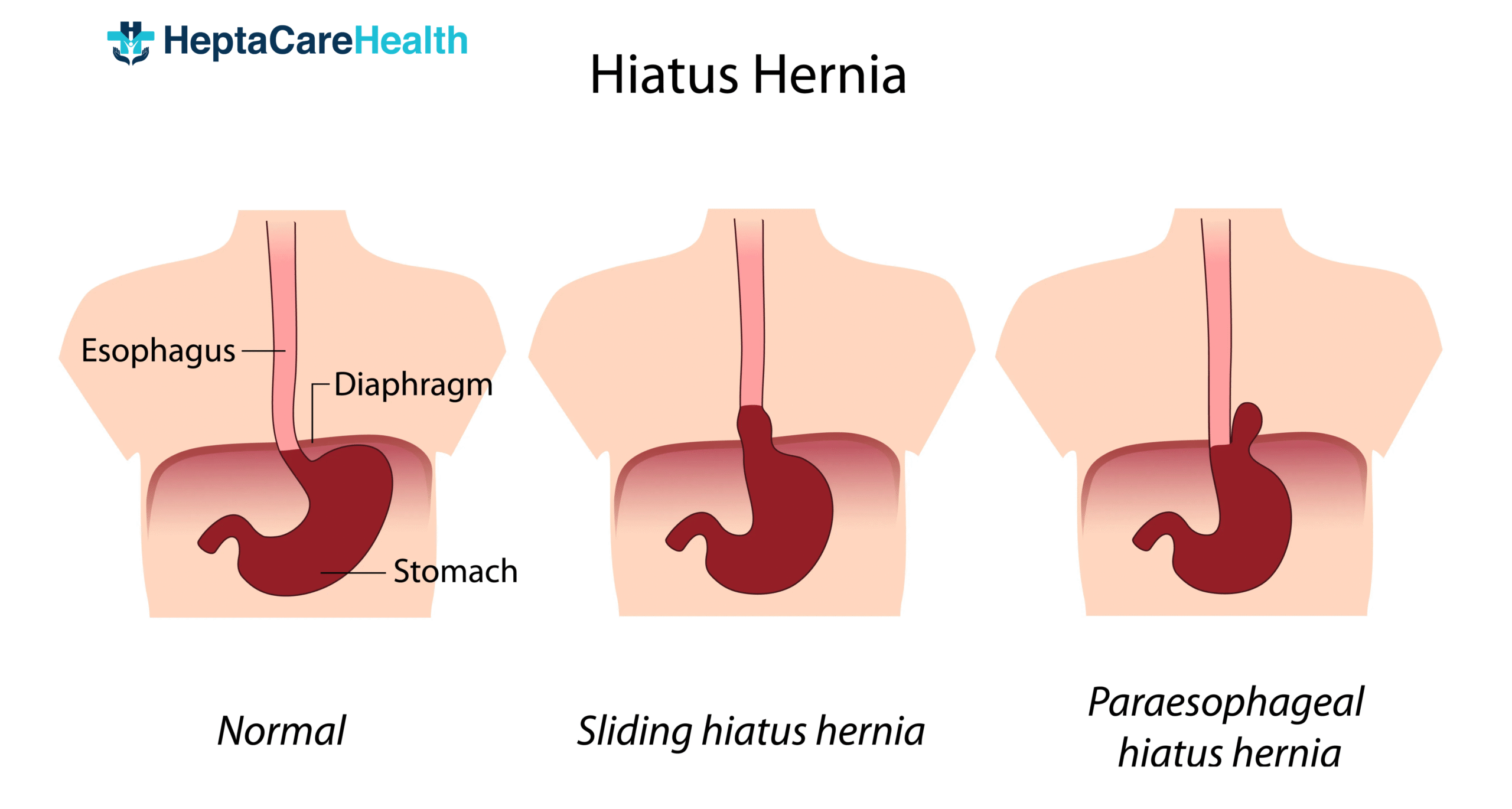 Hiatal hernia