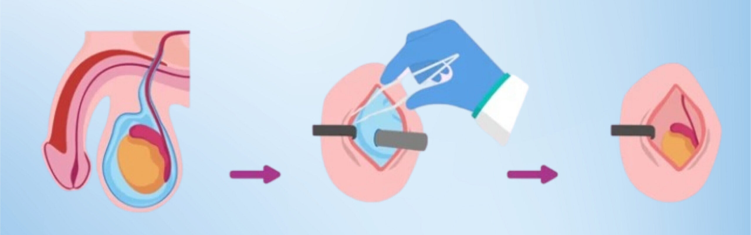 Hydrocele surgery