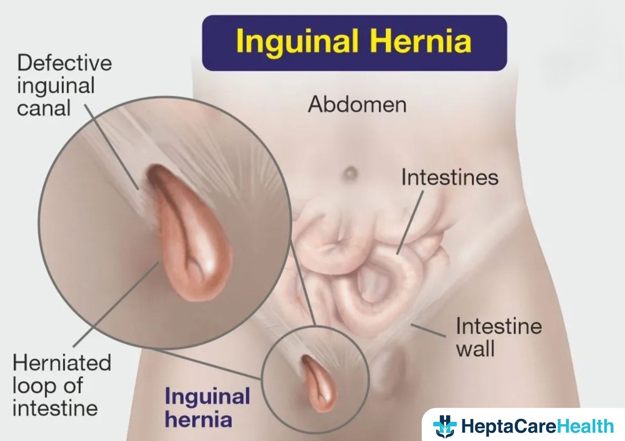 Inguinal hernia