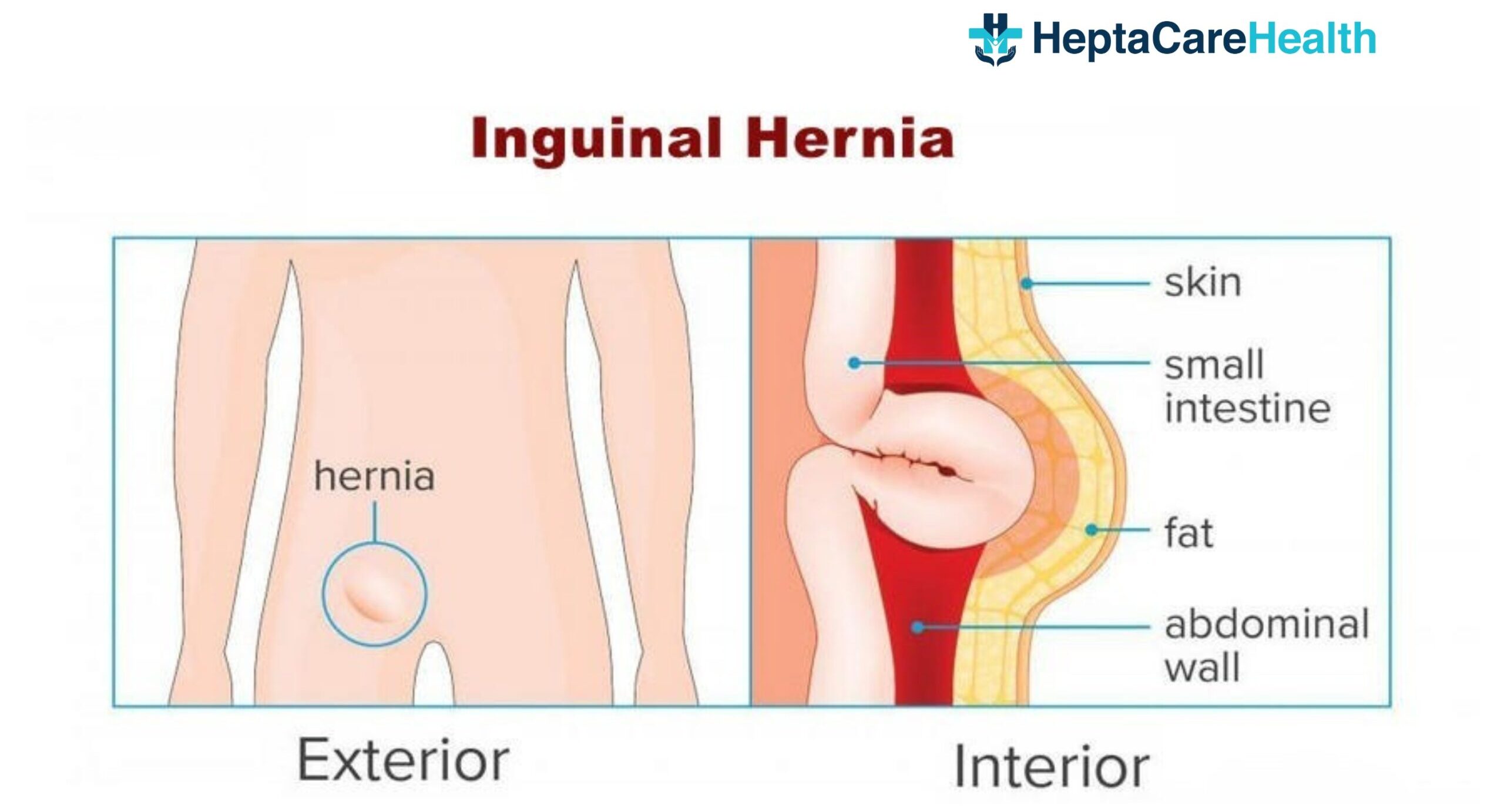 Inguinal hernia
