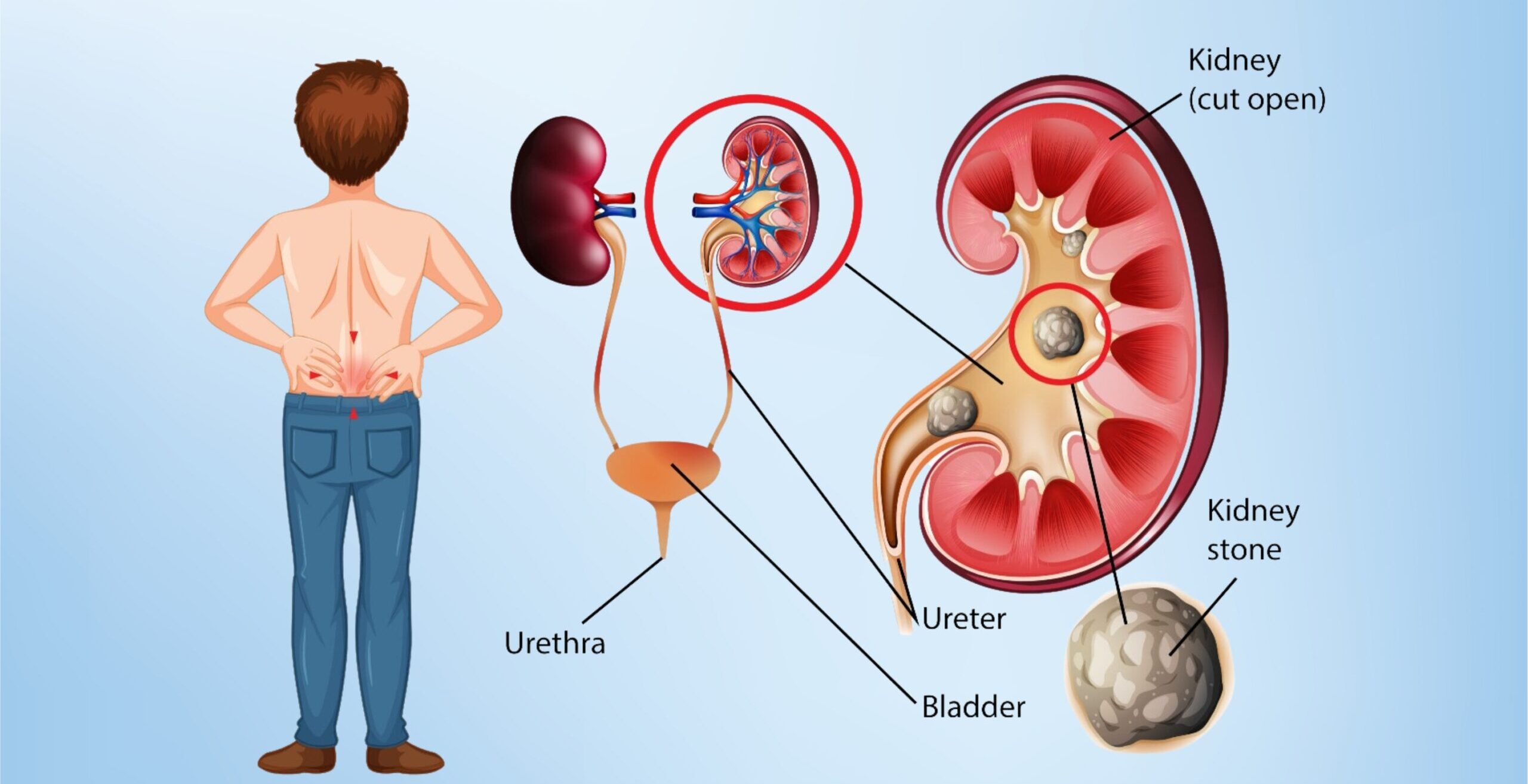 Kidney stones treatment