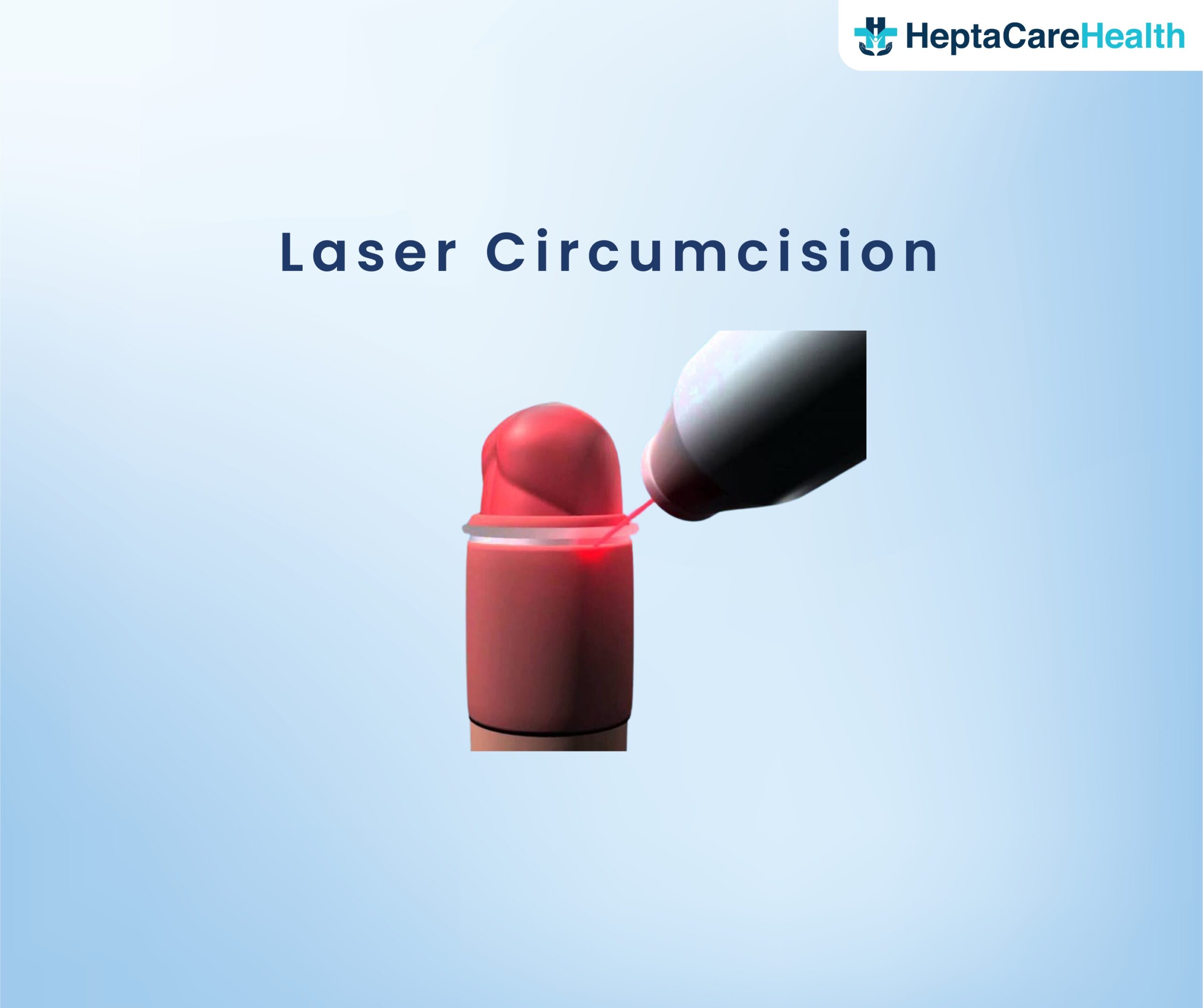 Laser Circumicision