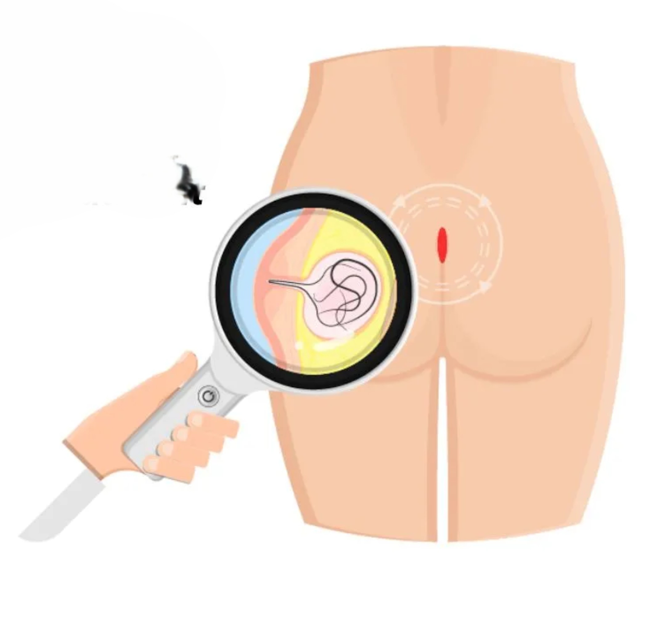 Pilonidal Sinus