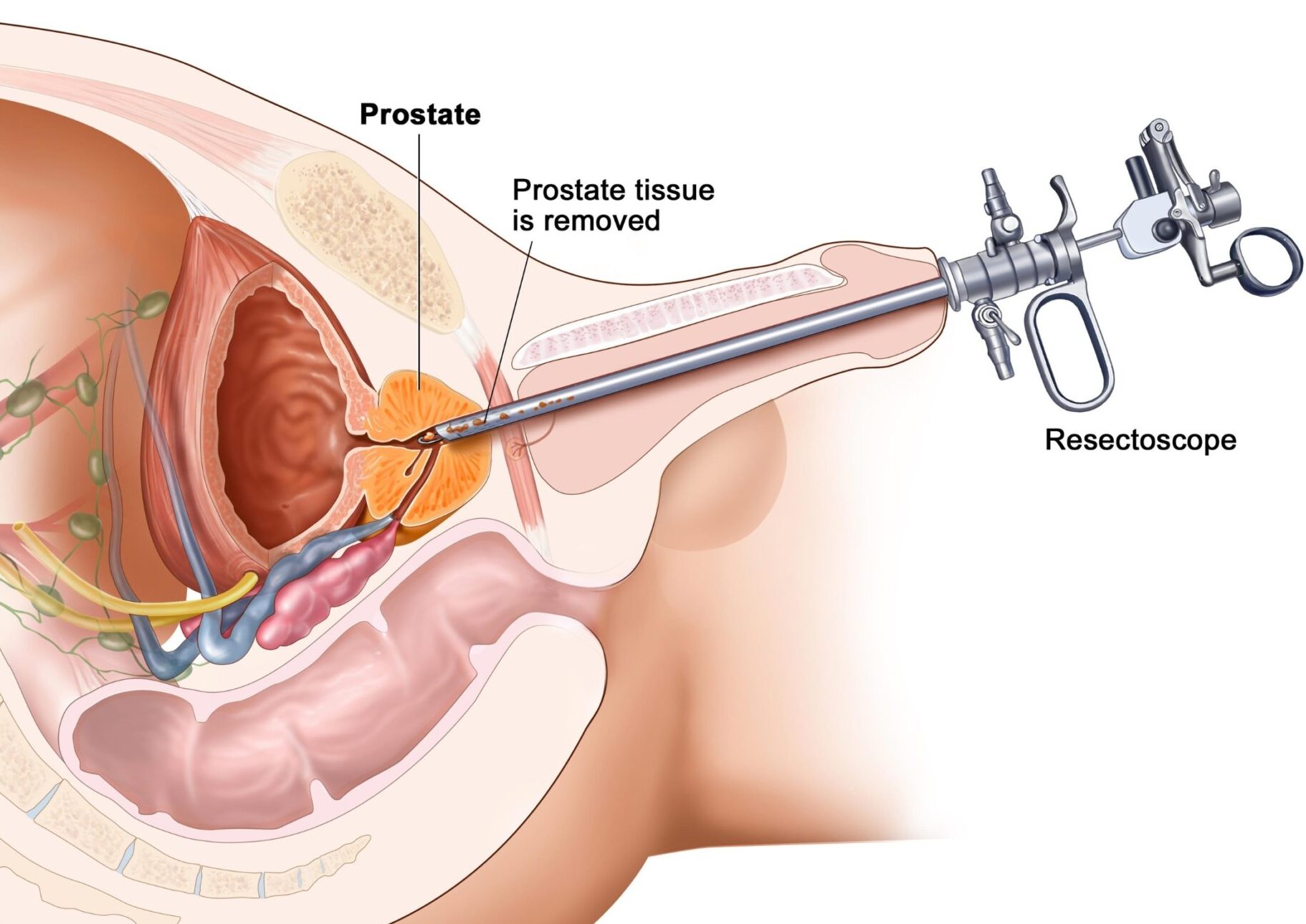 Prostatectomy