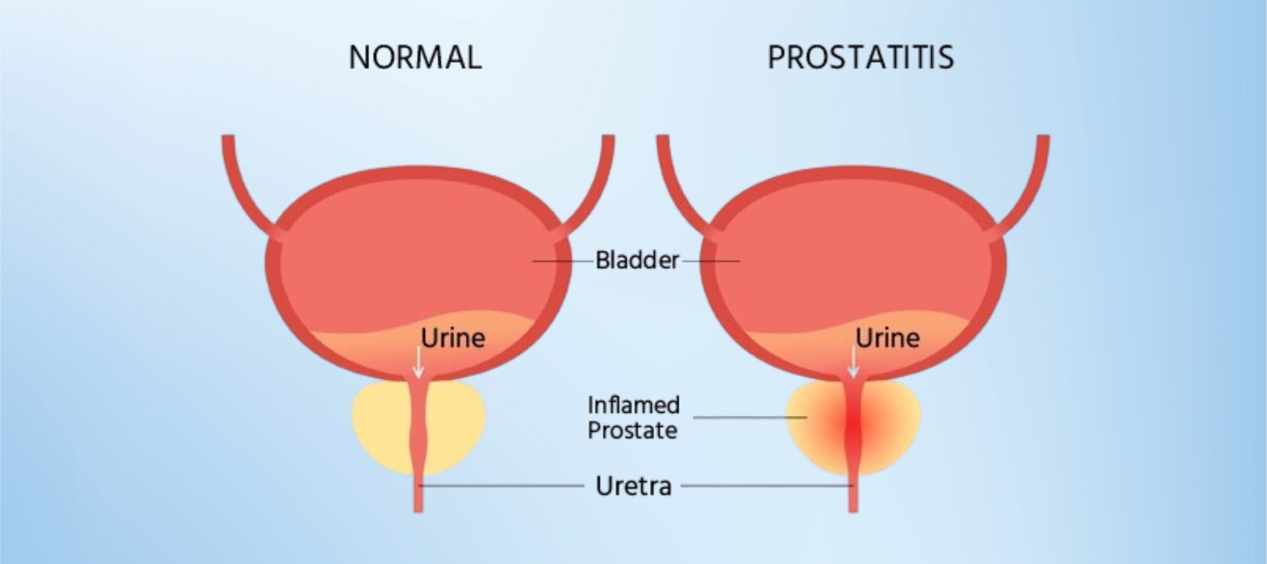 Prostatectomy