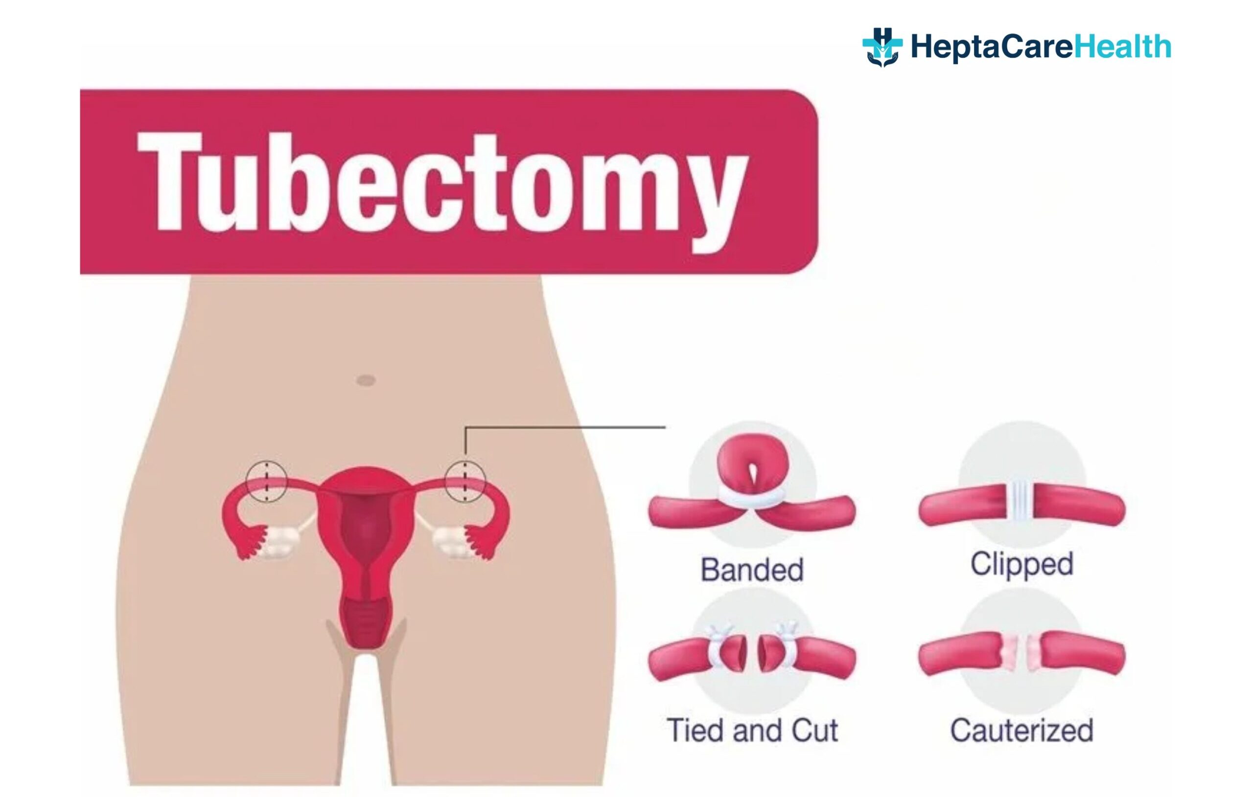 Tubectomy