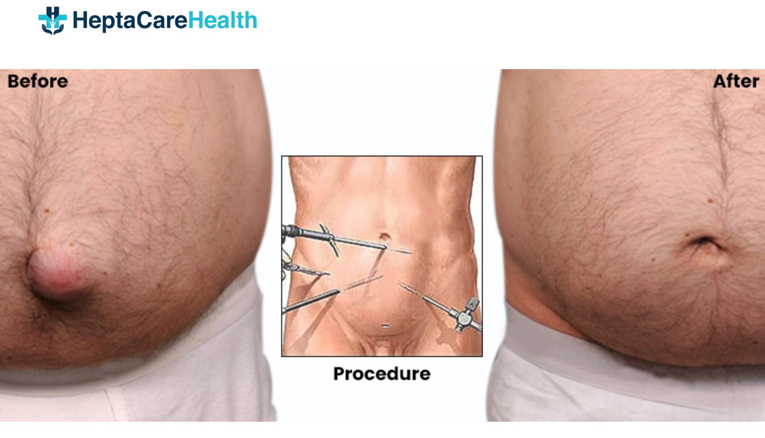 Umbilical hernia