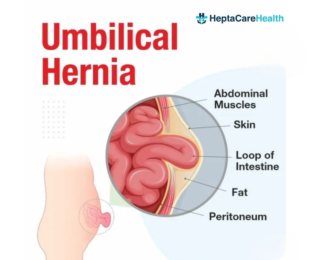 Umbilical hernia