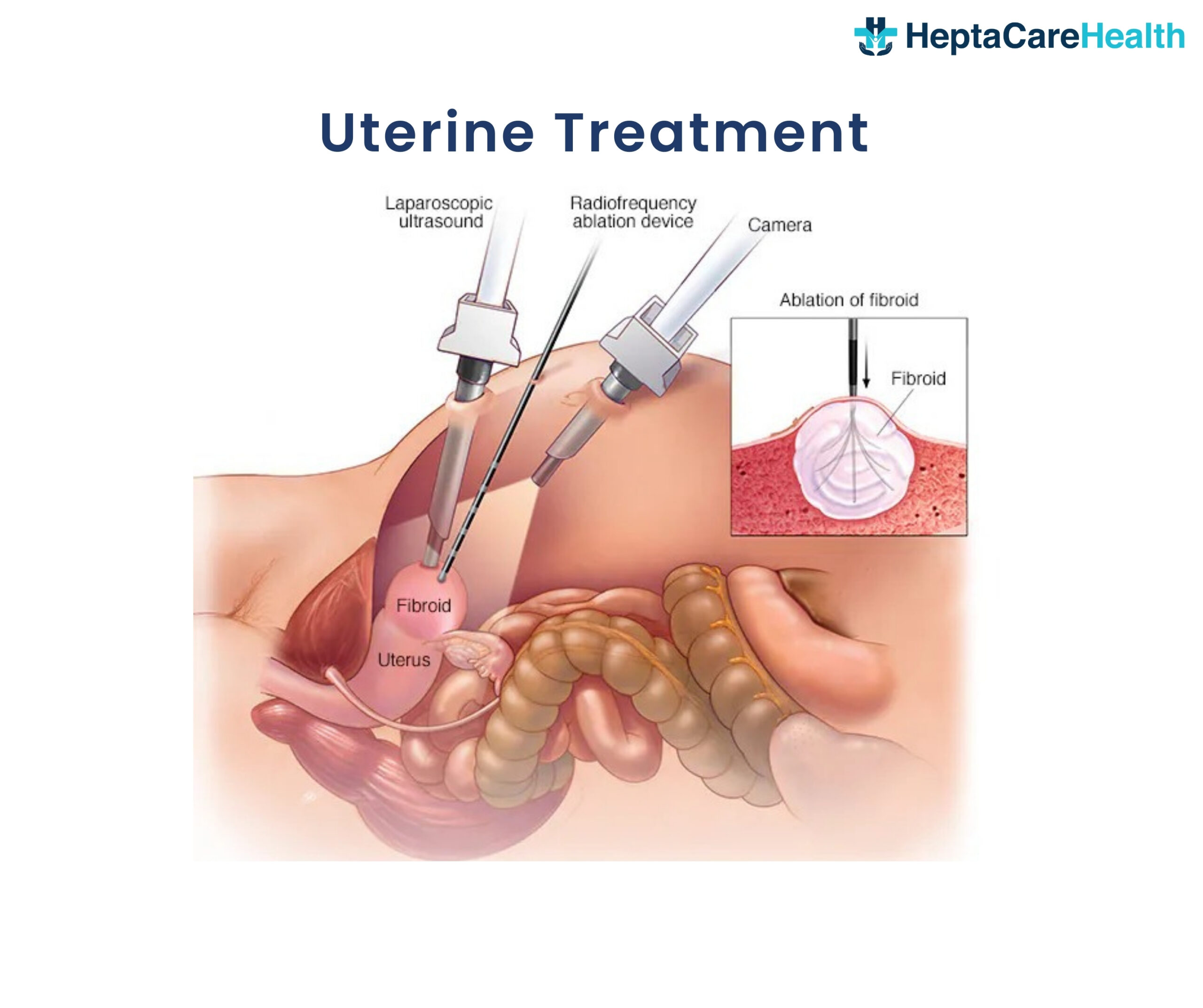 Uterine fibroid