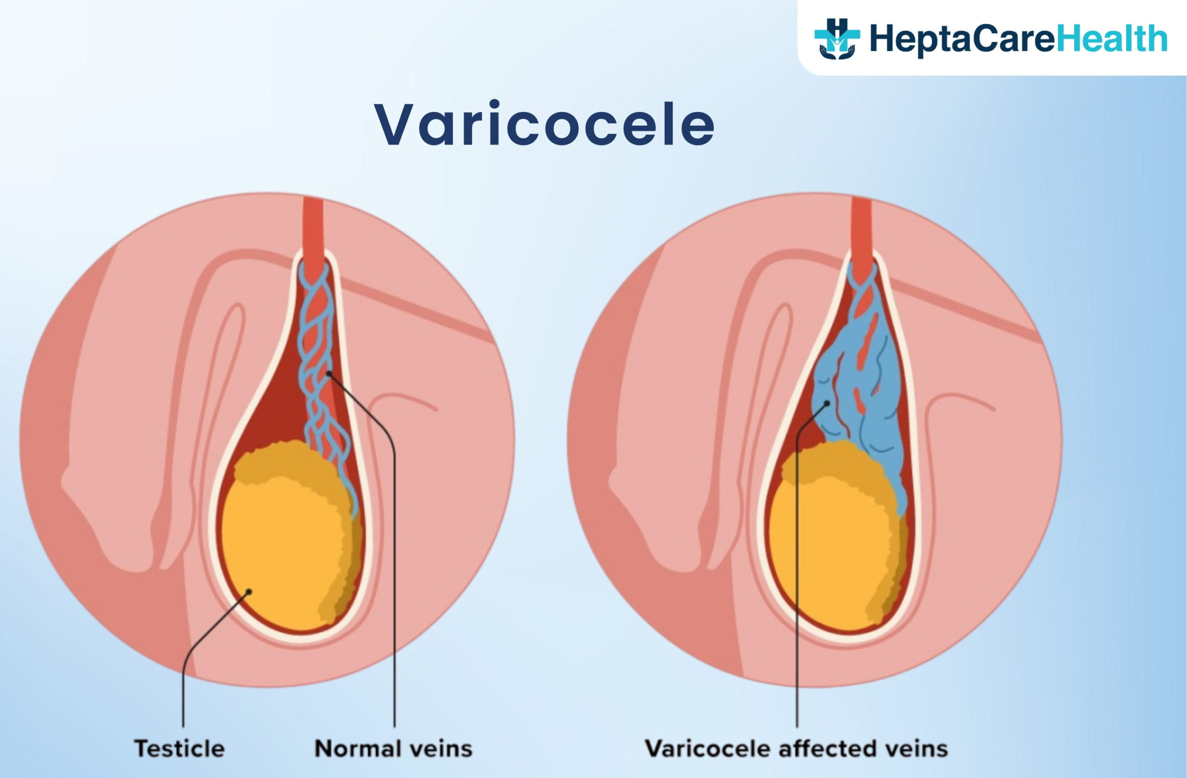 Varicocele