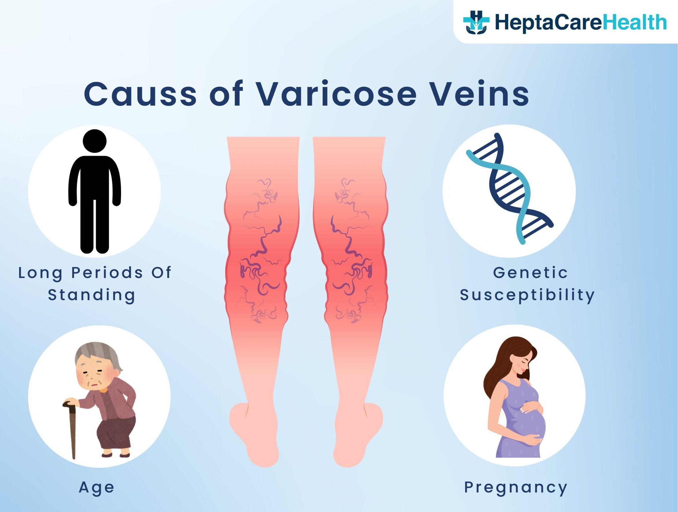 Varicose veins