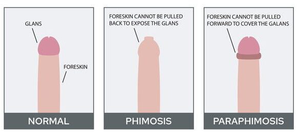 Foreskin infection