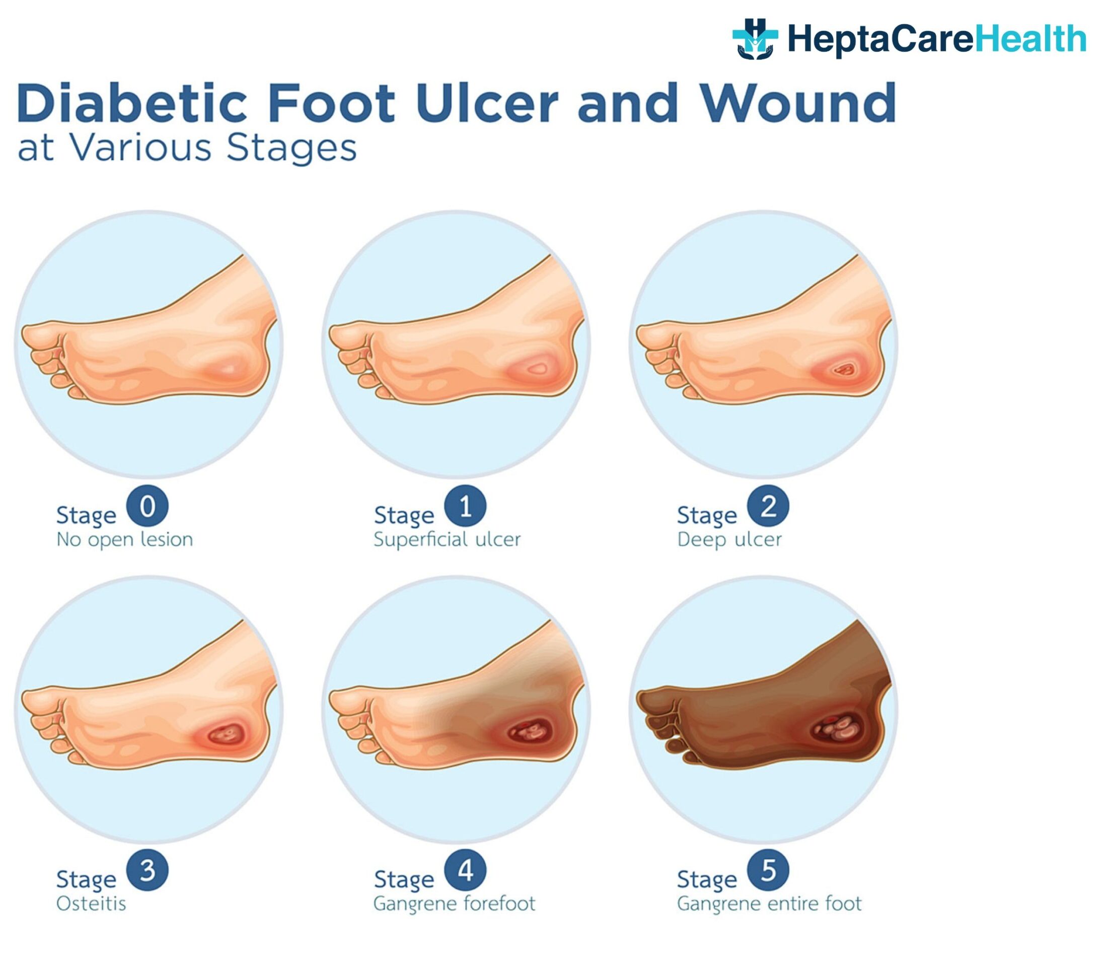 diabetic foot ulcer treatment