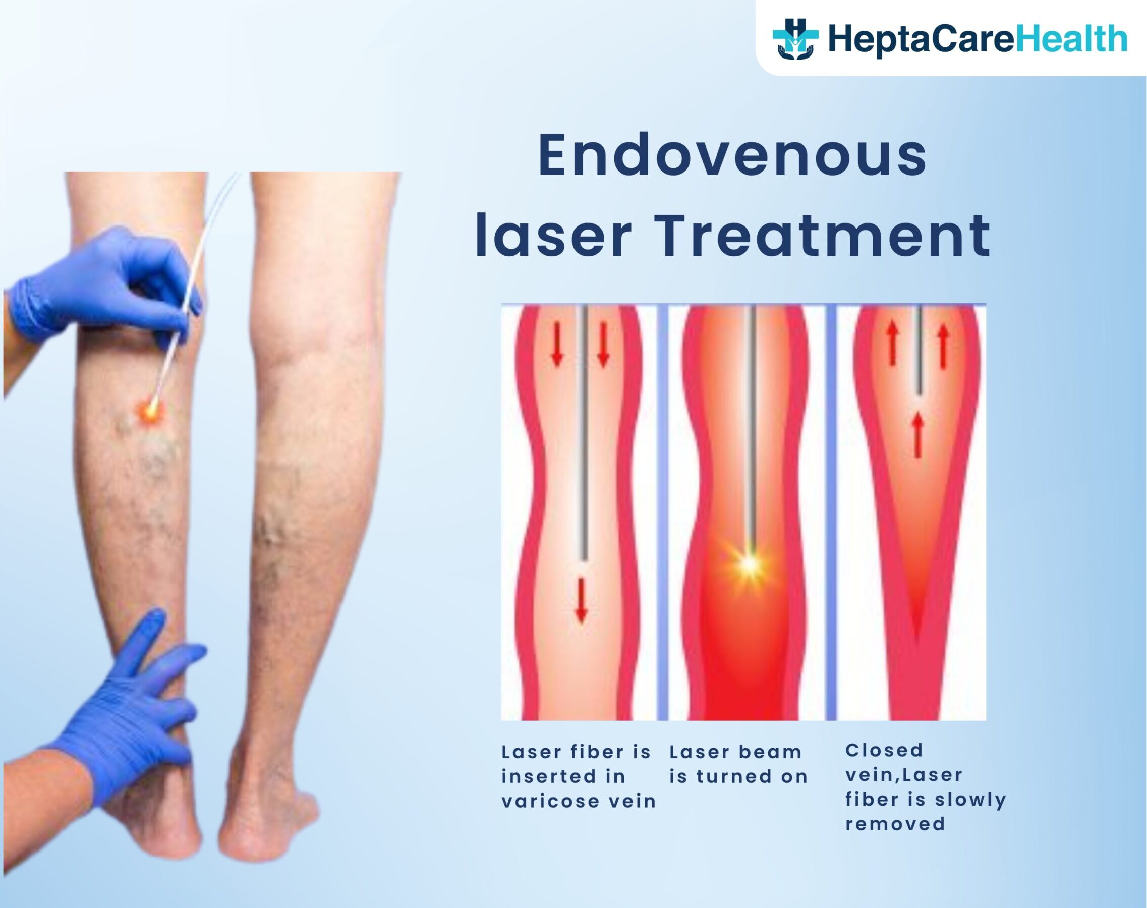 EVLT treatment