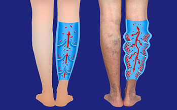 Compression Stockings for Varicose Veins