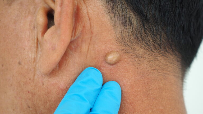 Sebaceous Cyst vs Lipoma – What are the Major Differences?