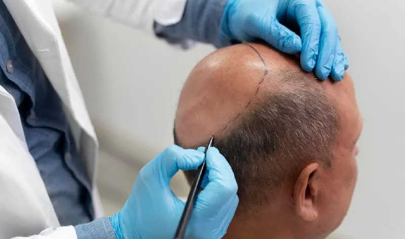 hair transplant