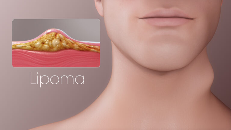 Lipoma Treatment: Simple Solutions for Those Fatty Lumps