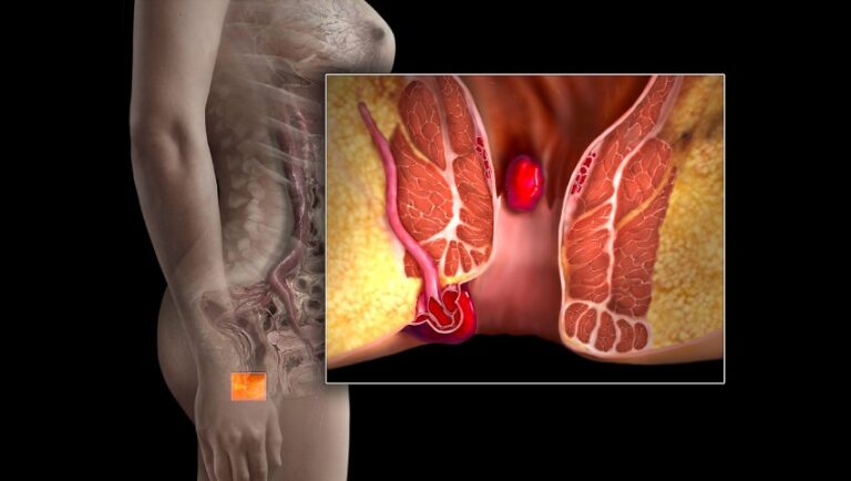 Dangers of Bleeding Hemorrhoids: Symptoms, Risks, and Treatment Options