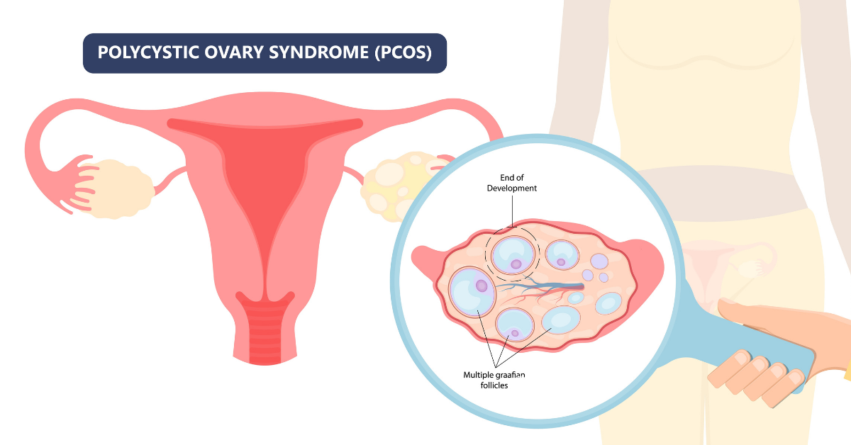 PCOS