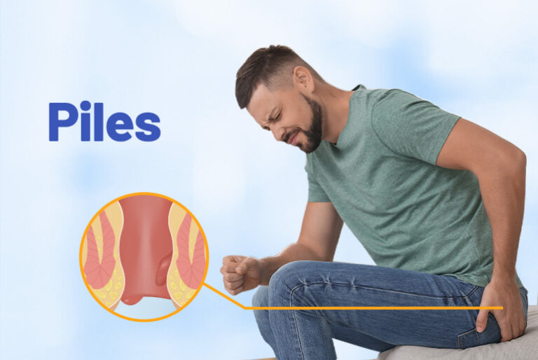 Stapled Hemorrhoidectomy: Modern Treatment for Piles