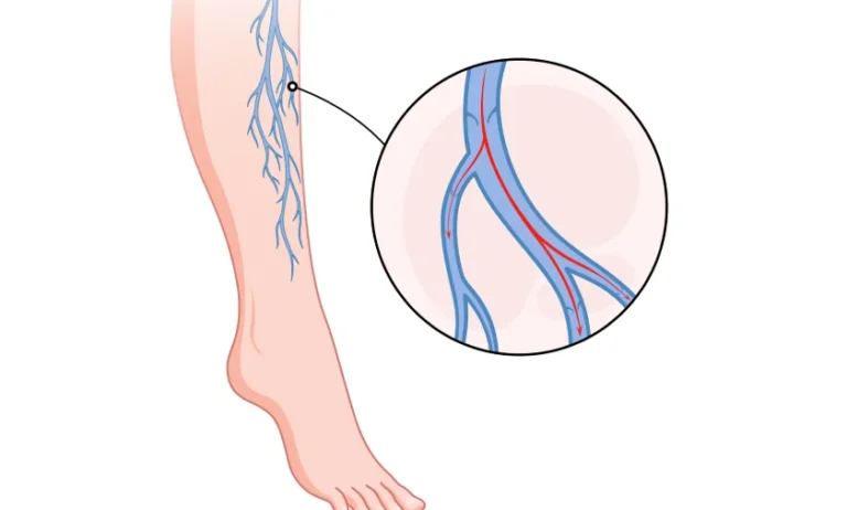 Importance of Early Detection in Vascular Disease – Best Vascular Treatment at Heptacare Health
