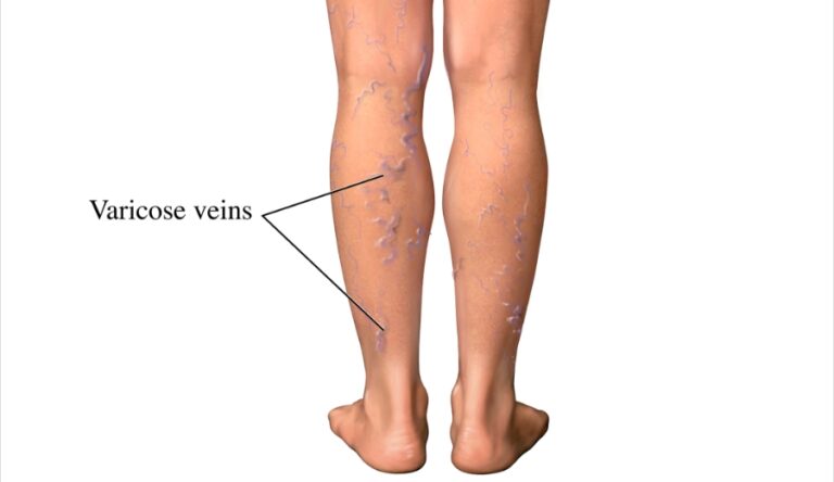 What is Deep Vein Thrombosis (DVT) and How is it Treated?