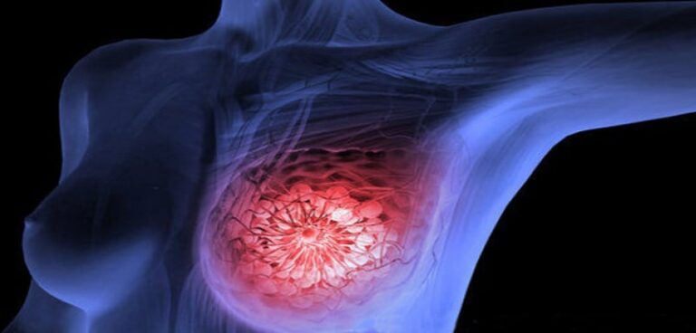 Triple-Negative Breast Cancer
