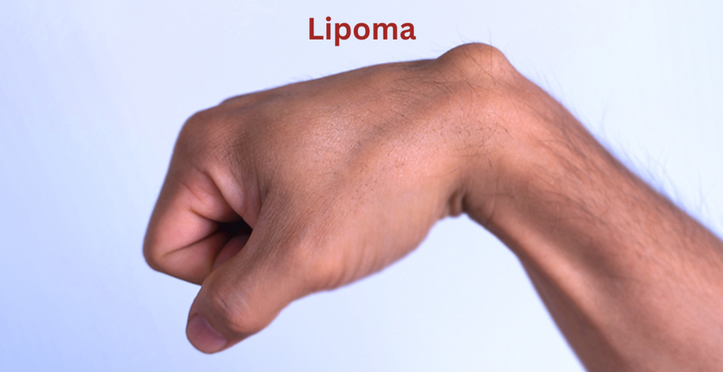 Lipoma Doctors near me
