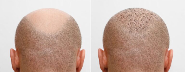 hair transplant