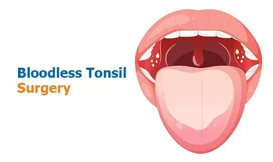Tonsil Removal Surgery Cost in Vizag, Vijayawada & Hyderabad – Laser vs Conventional Treatment Options
