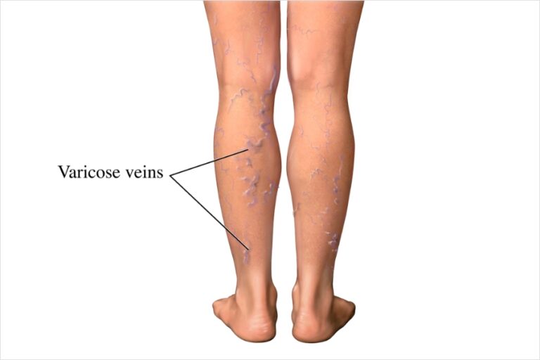Varicose Veins Symptoms: Early Signs to Watch for in Hyderabad & Vijayawada