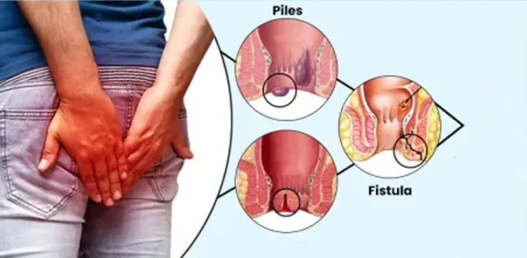 Expert Review: Best Laser Piles Surgeon Near Me for Fast Relief