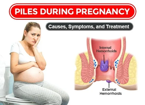 Piles During Pregnancy – Causes, Precautions & Safe Treatments