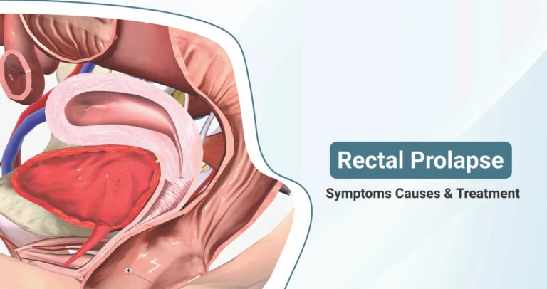 Can Rectal Prolapse Be Managed with Medicines Alone? – HeptaCare Health Explains