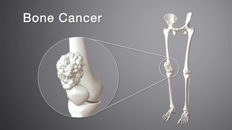 Research Reveals Genetic Link to Most Common Pediatric Bone Cancer